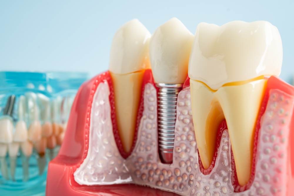 dental implants in nyc