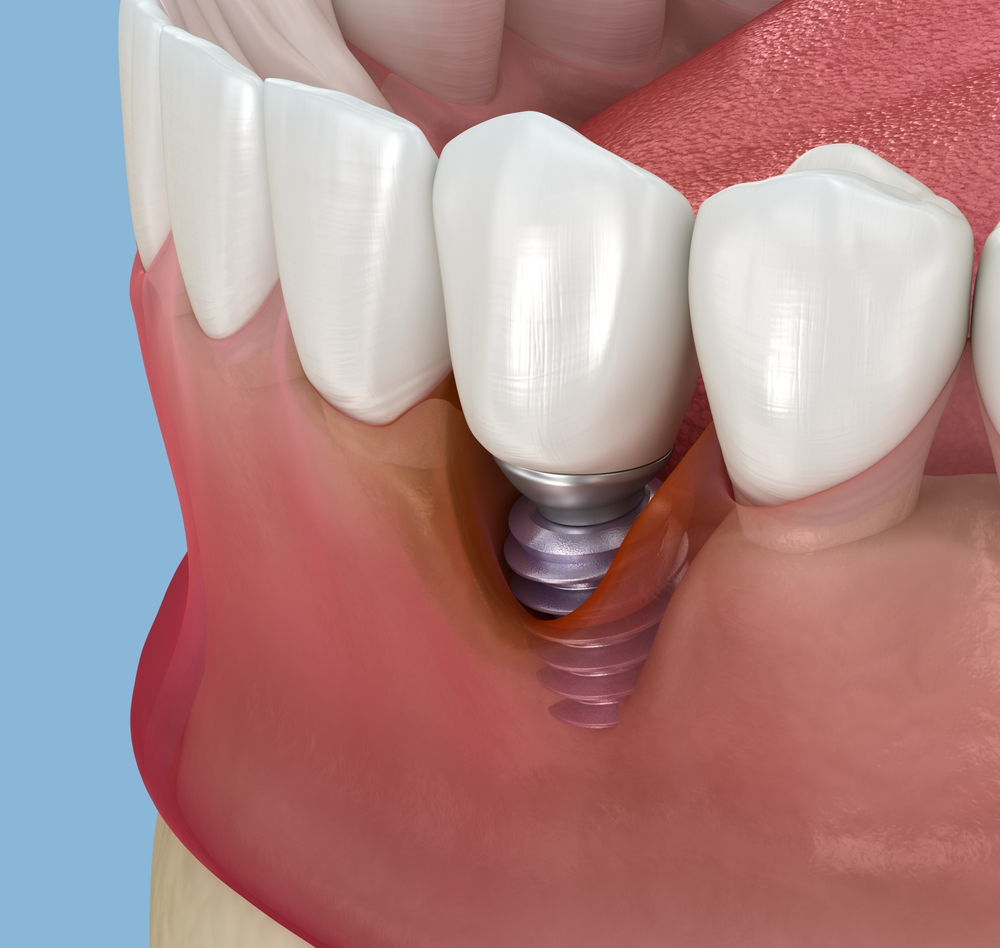 dental implants new york